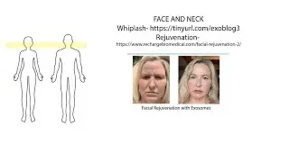 Are Exosomes a panacea from head-to-toe?