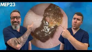 Narrow Ear Canals & Deep Ear Wax Plugs - MEP23