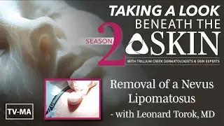 Beneath the Skin - Removal of a nevus lipomatosus