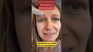 Curso Online de FIBROBLAST con PLASMAPEN