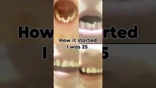This is my history #braces #dentist #orthodontist #smile #teeth #brackets #shorts