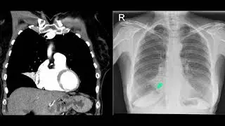 Right middle lobe collapse on the chest x-ray and CT scan. Guaranteed exam material