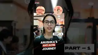 Acne Treatments and Solutions | Anti-Acne Journey | Juvena Herbals Client Testimonials | Part-1