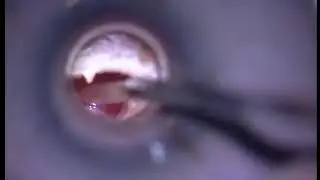 Kulakta sıvı ve tüp takılması