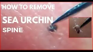How to remove sea urchin spine.