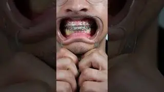 Removing buildup from braces 😳