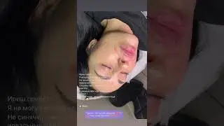 Увеличение губ и заполнение носогубных  складок #воронеж #косметолог