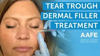 Under Eye Dermal Filler Treatment | AAFE