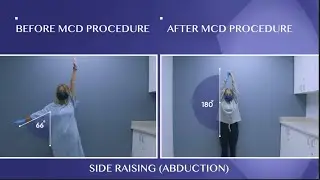 Patient's Frozen Shoulder Cured!