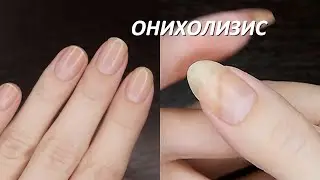 Treating onycholysis, trimmed my nails