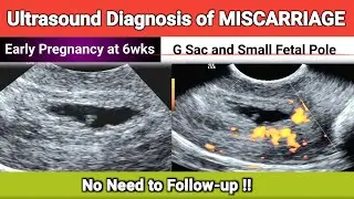MISCARRIAGE at 6wks | No Need to Follow-up