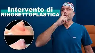 Rinosettoplastica Funzionale ed Estetica: Esperienza di Dario (vlog 02)