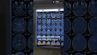 What’s the lesion seen in MRI Brain ?