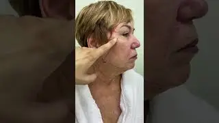Глубокая подтяжка лица + медиальная платизмопластика в моём исполнении. Часть 2.