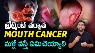 Mouth CANCER TREATMENT in telugu | ట్రీట్మెంట్ తర్వాత నోటి క్యాన్సర్ మళ్లీ వస్తుందా | Dr.Avinash