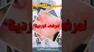 اسرار العناية بالبشرة الحساسة او الملتهبة (هام لمرضى الوردية بالوجه)