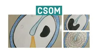 CSOM (Chronic suppurative otitis media) | The White Army