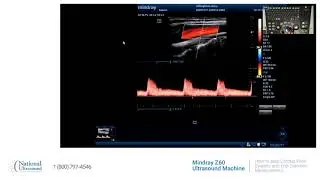 How to take carotid peak systolic and end diastolic measurement on Mindray Z60