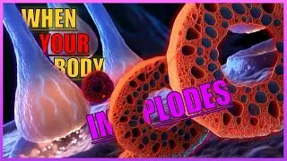 When Your Body Implodes | Easily Explained