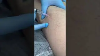 Склеротерапия для лечения вен