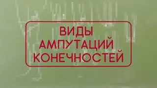 Виды ампутаций конечностей