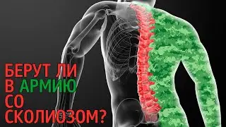 Сколиоз и армия | С каким сколиозом не берут в армию?