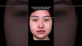 How to slim the face with liposuction and buccal fat pad reduction by Dr. Hooman Khorasani