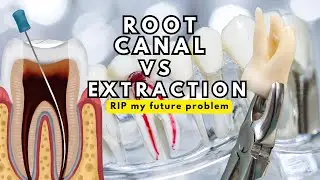 Root Canal vs. Tooth Extraction: what's the RIGHT Choice?