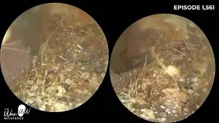 1,561 - Rock solid #earwax plugs removed using the Rai Angled Ear Hook & Rai Angled Ear Pick