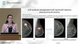 Противоопухолевая терапия - лечение без скальпеля? (Алексеева Ю.В.)