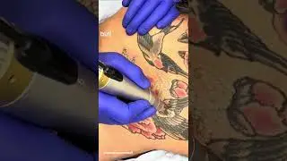 Nervous about tattoo removal?