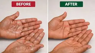Super Glue Comes Off Skin in Seconds! How to Remove Super Glue Safely!