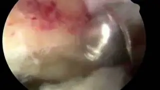 Hip Arthroscopy Rim Trimming