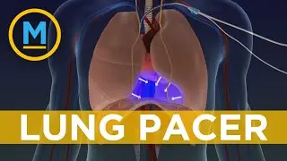 B.C. professor's lung device approved for use | Your Morning
