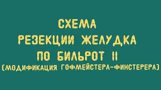 Схема резекции желудка по Бильрот II (модификация Гофмейстера-Финстерера)