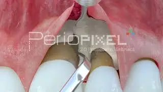 Vídeo 3D Preservación papila Takey - Tráiler