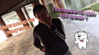 Почему не поставили брекеты ? || У меня аллергия на металл ||