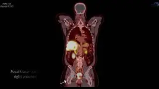 PSMA PET/CT F-18 Case 10