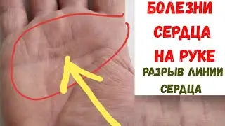 Болезни сердца на руке / Разрыв на линии сердца / Хиромантия