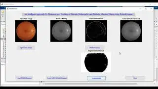 Detection of Diabetic Macular Edema in Retinal Images using Matlab | Matlab Projects Help