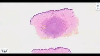 Skin: Dermatofibroma Microscopy (Talking slide)