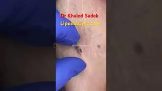Massive blackhead extraction Dr Khaled Sadek 