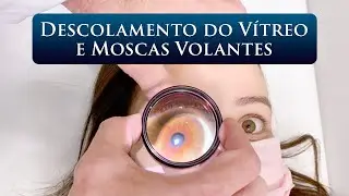 DESCOLAMENTO DO VÍTREO E MOSCAS VOLANTES
