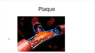 What is embolus? vascular disease.