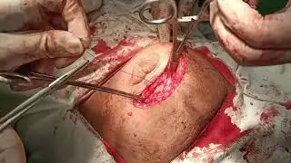 Irreducible Umbilical Hernia