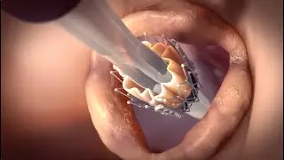 Transcatheter aortic valve implantation (TAVI) via the transfemoral route