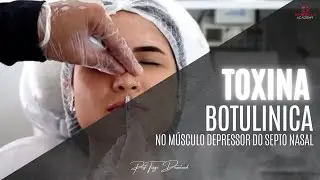 Toxina botulínica no músculo depressor do septo nasal