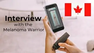 Melanoma Warrior story: Karen