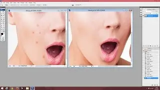 Photoshop ile Sivilce Yok Etmek
