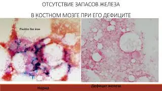 Анемии